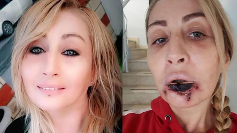 Estetik Yaptırdığı Dudağı Çürüdü!