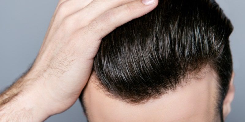 Saç Nakli Hakkında Bilinmesi Gerekenler