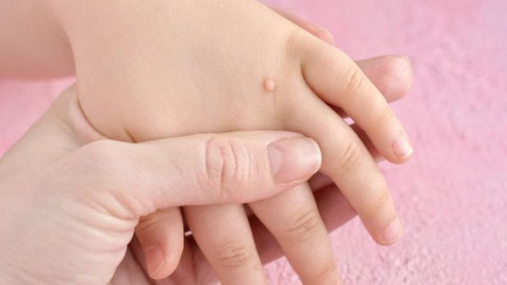 Siğillerden Doğal Yollarla Kurtulmak Mümkün Mü?