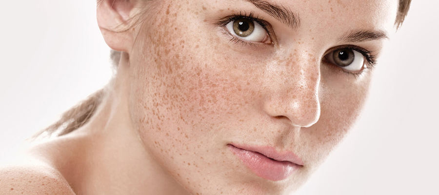 İşte Cilt Lekelerine Neden Olan 6 Sebep