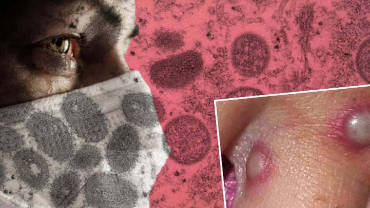 “Maymun Çiçeği” Bir Ülkede Daha Görüldü!