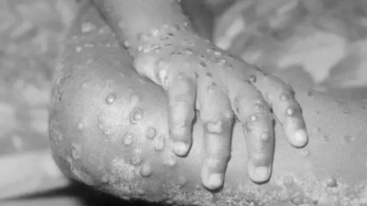 Türkiye’de Maymun Çiçeği Görüldüğü İddiasına Sağlık Bakanlığı’ndan Yalanlama