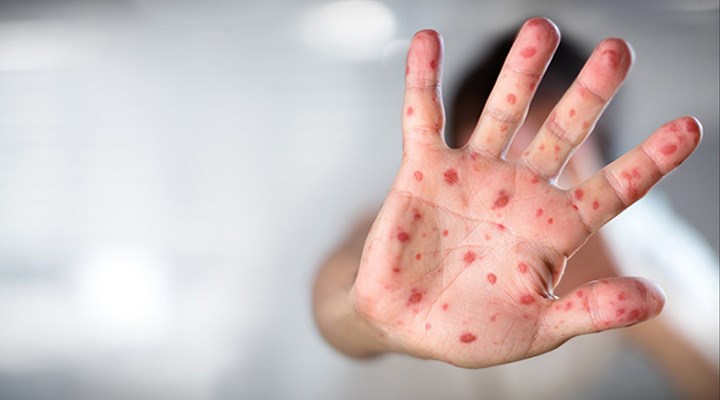 Maymun Çiçeği Nasıl Bulaşır? Maymun Çiçeği Aşısı Var Mı?