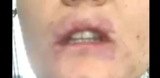 Dudak Dolgusu Kabusla Sonuçlandı