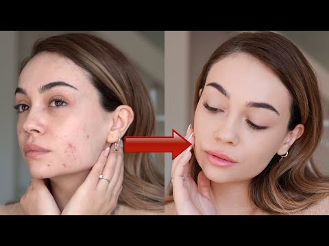 İmex Sivilce Kremi Nedir, Ne İşe Yarar?