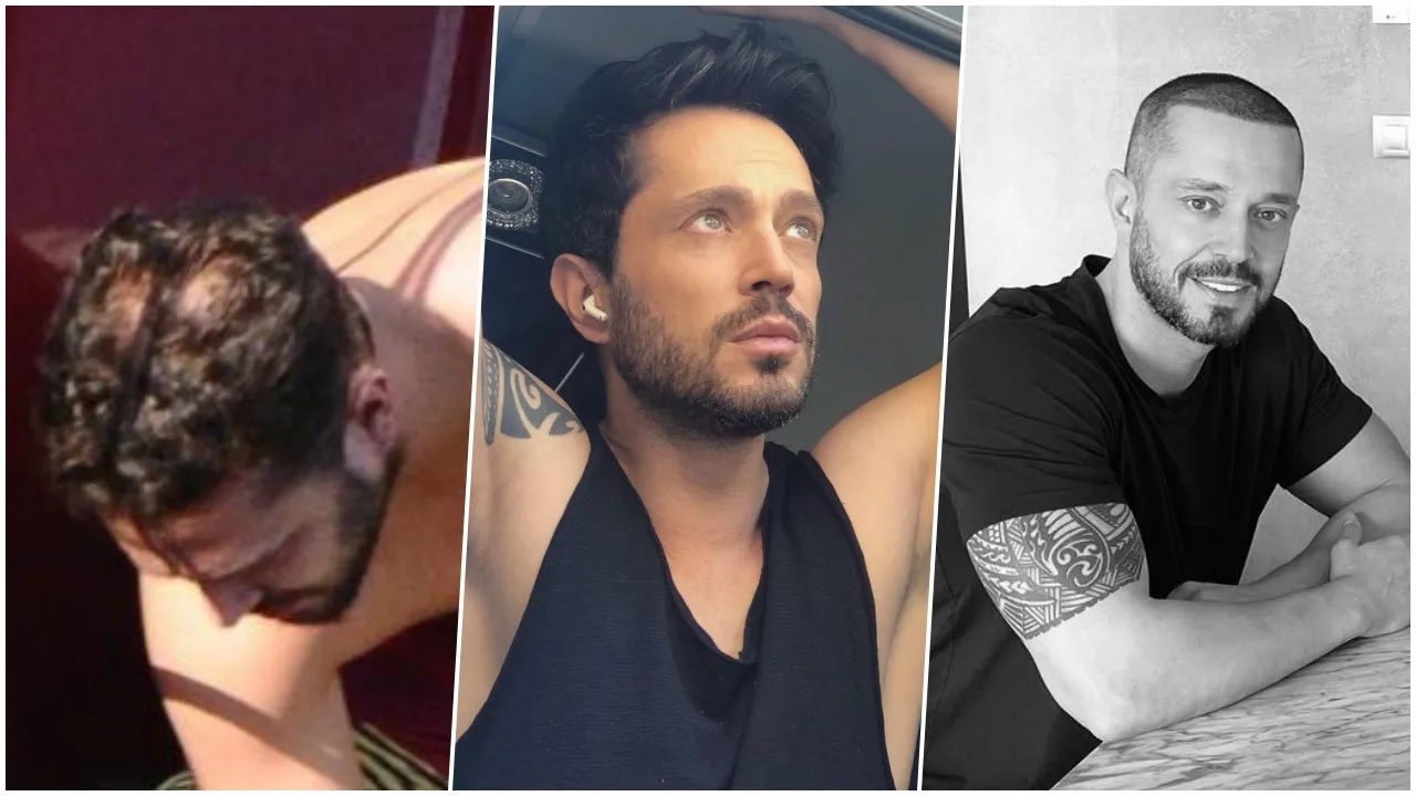 İşte Saç Ektiren Murat Boz’un Son Hali