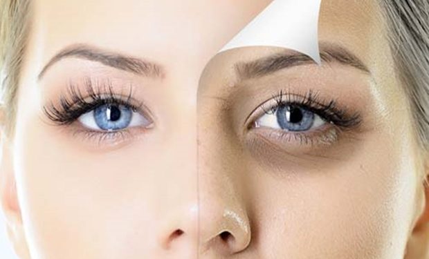 Göz Altı Morlukları Neden Olur, Nasıl Geçer?