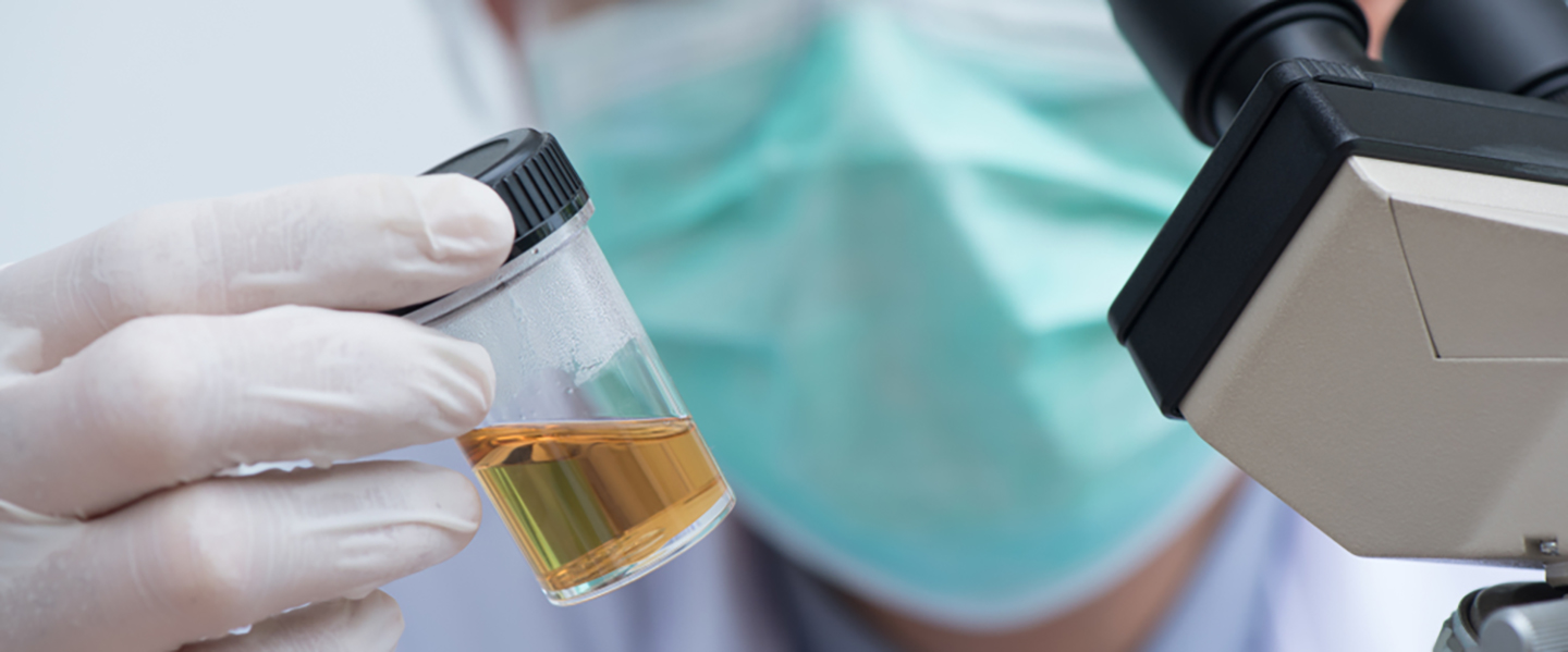 İdrarda Dansite Nedir, Yüksek Dansite Belirtileri Nelerdir?