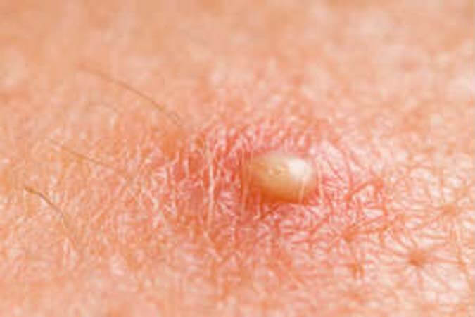 Folikülit (Kıl Kökü İltihabı) Nedir? Folikülit Neden Olur?