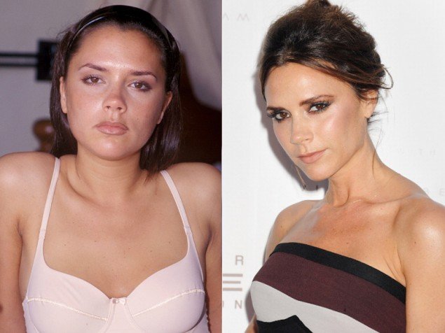 Victoria Beckham'dan Estetik Açıklaması!