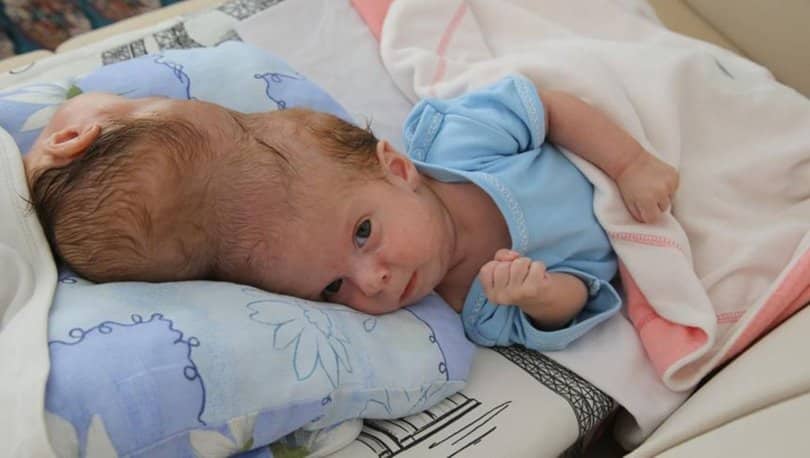 Siyam İkizlerinin Ameliyatı Başarıyla Sonuçlandı