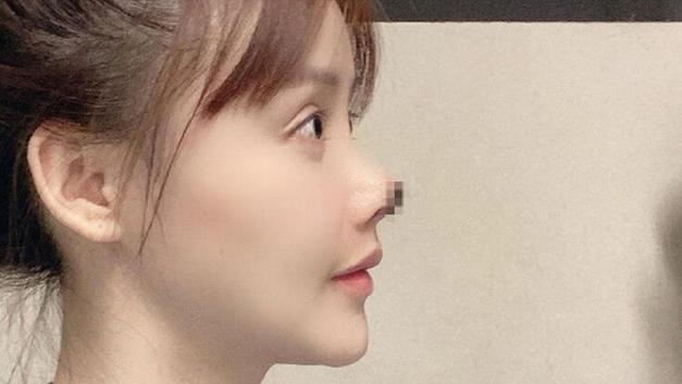 Estetik Sevdası Kabusu Oldu: Burnu Çürüdü!