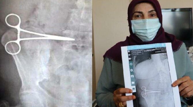 Karnındaki Makas 2 Ay Sonra Alındı!