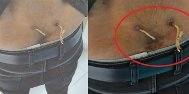 Çamaşır İpiyle Bel Tedavisi Şok Etti!