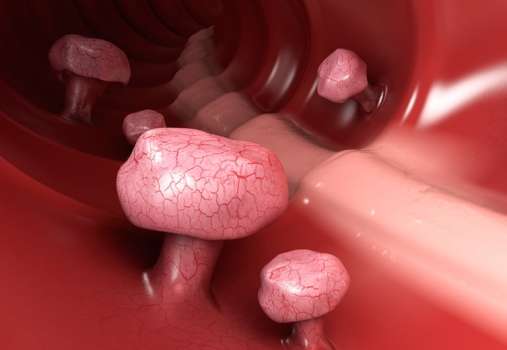 Polip Nedir, Neden Olur? Polip Çeşitleri Nelerdir?