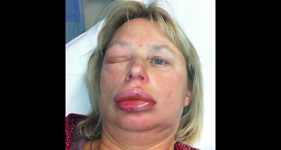 Herediter Anjioödem Nedir? Kökeni, Nedenleri ve Belirtileri Nelerdir?