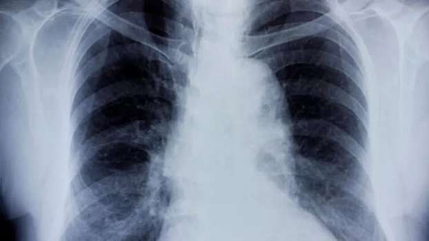 Bronşit Nedir? Bronşit Belirtileri Nelerdir?