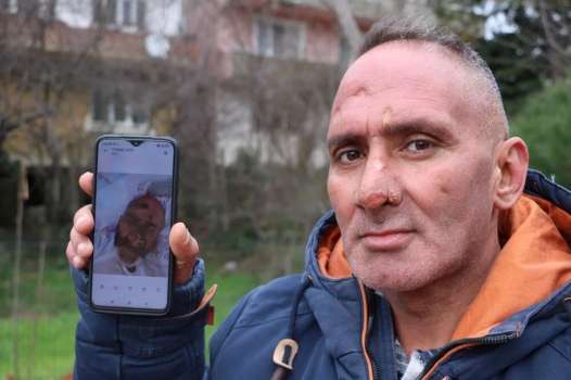 Sinek Isırığı Yüzünden Tanınmaz Hale Geldi