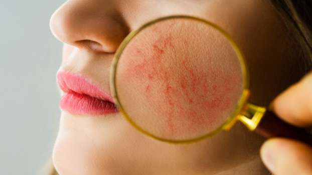 Lupus Nedir? Belirtileri Nelerdir?