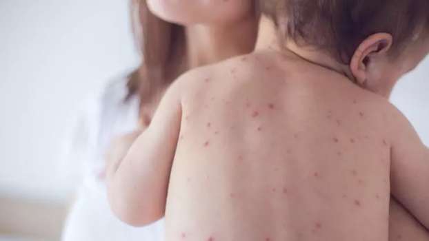 Kızamık nedir? Kızamık Belirtileri ve Tedavi Yöntemleri Nelerdir?