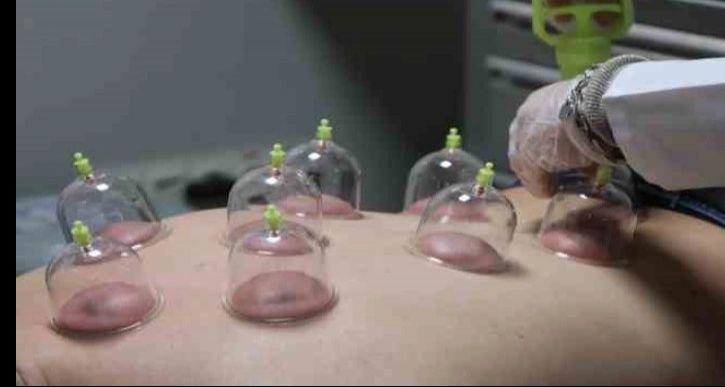 Hacamat Nedir? Faydaları Nelerdir?