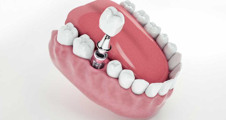 Milyonları İlgilendiren Düzenleme: Diş İmplantı Kapsamda Mı?
