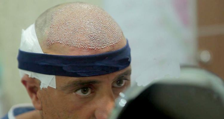 Kök Hücre ile Saç Ekimi ve Saç Klonlama: 2025 Fiyatları ve Detaylar