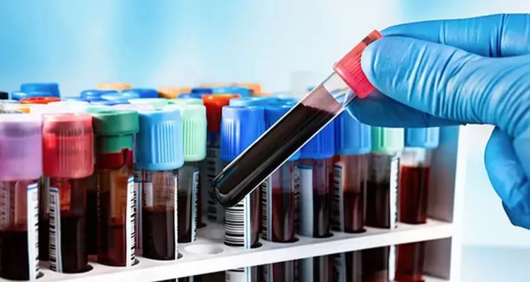 Yeni Kan Grubu Gwada Negatif Keşfedildi: Dünyada Tek Taşıyıcısı Var